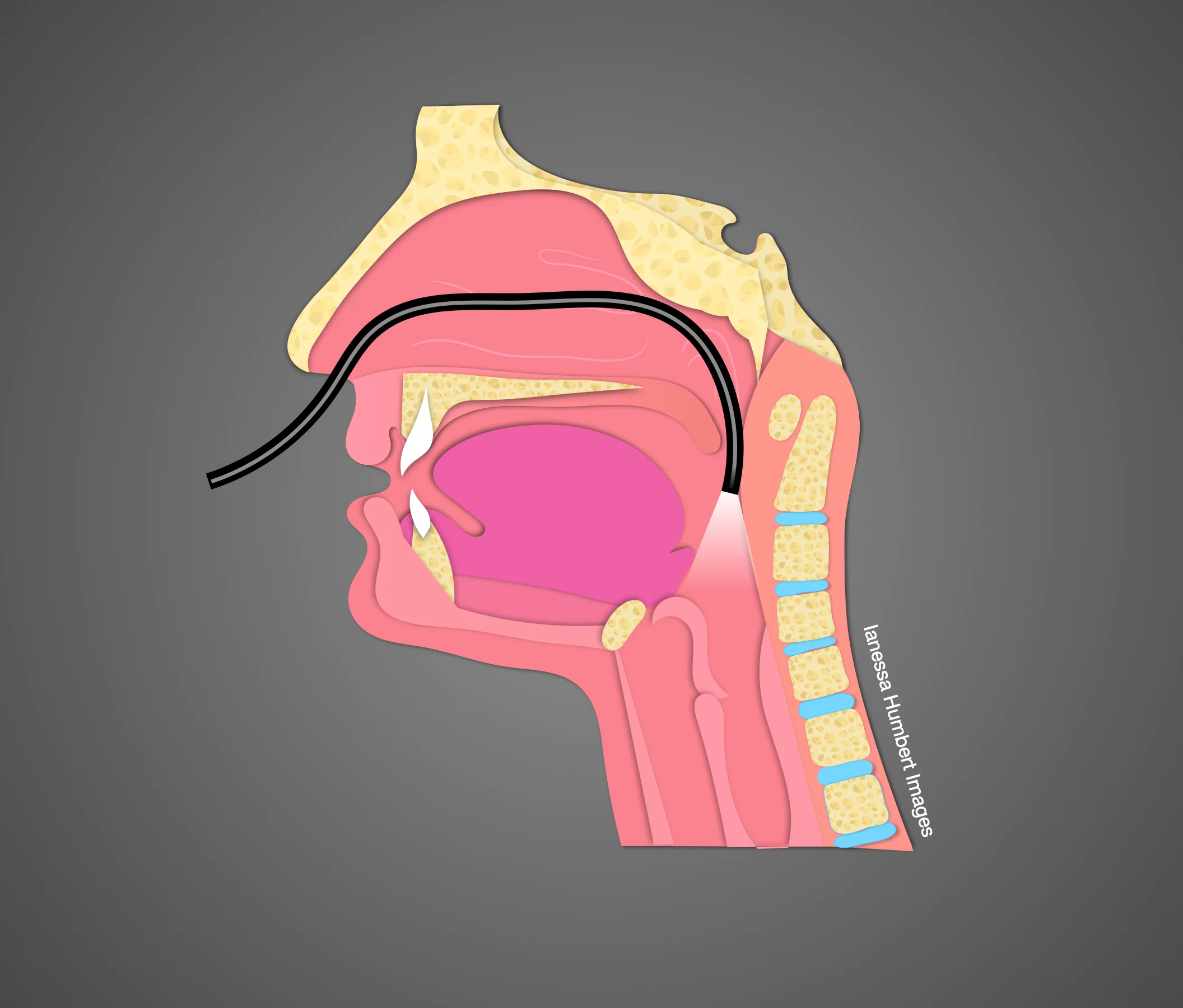 Dr. Humbert's illustration of the thin FEES camera passing through the nose to the throat