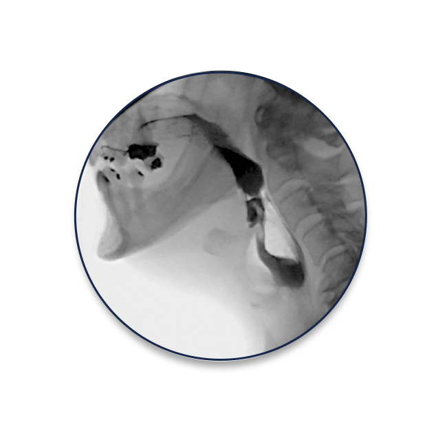 A real swallow X-ray image from a videofluoroscopy study